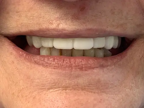The same patient's smile after treatment