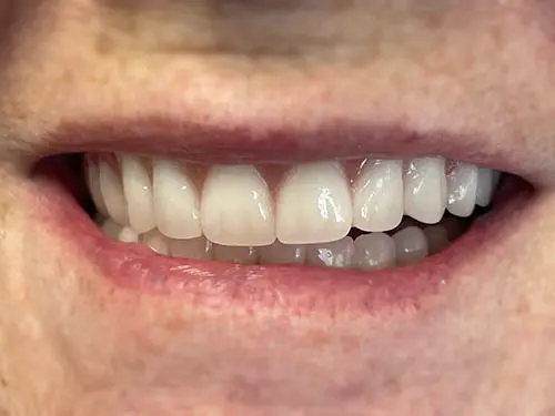 The same second patient's smile after treatment