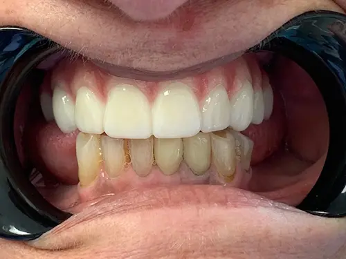Patient smile before treatment
