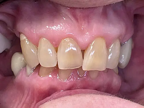 A second patient's smile before treatment